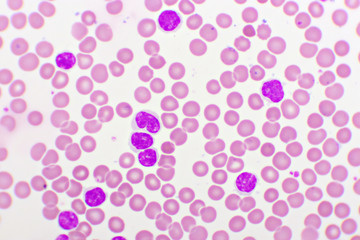 Picture of acute lymphocytic leukemia or ALL cells in blood smear, analyze by microscope, 1000x