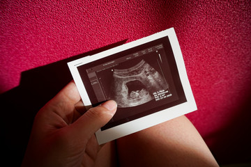 pelvic screening ultrasound, pregnancy 10 11 weeks, photo of the embryo on the lap of a woman on a pink background,  waiting for a girl       