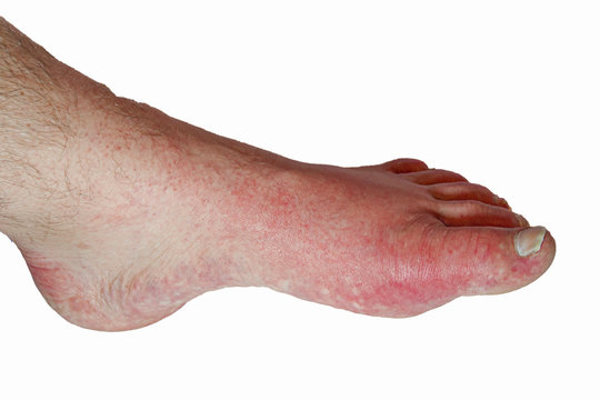 Foot of Gout swollen isolated on white