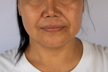 An Asian woman with the Nasolabial folds (cheeks lines) and skin problem such as wrinkles and dark spots on her face.