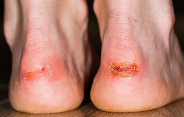 Painful injury on heel