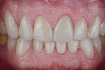 Obraz premium The perfect and natural-looking teeth