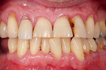 The periodontitis and spacing teeth