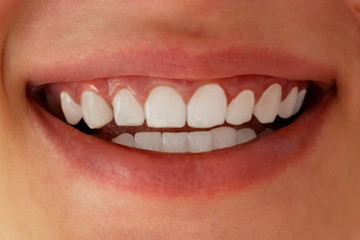 White teeth close-up. Dental whitening.