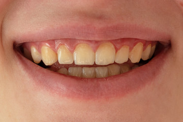 Mouth with natural teeth. Teeth without whitening.