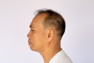 Obraz premium Hair loss Asian man showing all side of his bald head