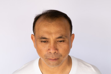 An Asian man with hair loss