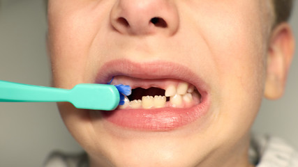 Naklejka premium 6 years kid showing missing teeth, he has lost two calfs teeth. Close up portrait of blonde caucasian boy brushing his teeth without two front teeth.