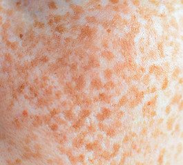 skin with freckles, close-up, macro