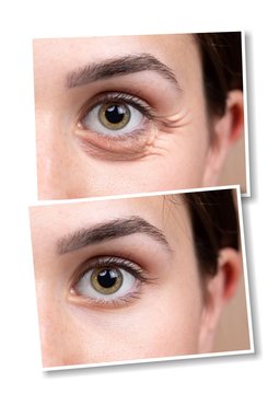 Collage from closeup views of woman eyes. Comparison of before and after beauty care intervention. Health and skin care concept...