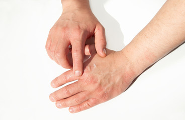 to smear hands with a cream from dermatitis and reactions to allergies. Minor abrasions and wounds...