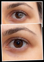 Collage comparison of young caucasian female eye. Comparing healthy eye and eye suffering from...