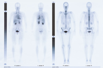 Bone scintigraphy or scintigram of the whole body of a 50 year old woman, showing arthrosis at the...