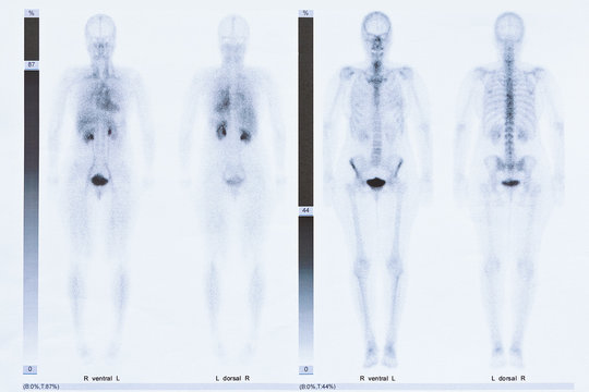 Bone scintigraphy or scintigram of the whole body of a 50 year old woman, showing arthrosis at the thoracic spine