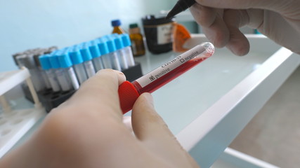 Hand of laboratory worker marking as positive blood samples to COVID-19. Scientist testing and examining test tube with blood sample to coronavirus. Concept safety life from pandemic of corona virus