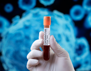 Coronavirus COVID 19 nCov Outbreak. New Corona Virus Blood Test Tube from Patient. Positive Case of Korona Virus Europe, Italy, Wuhan, China. Epidemic and Pandemic infection