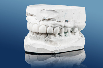 medicine, tooth, dentistry, impression, prosthesis, dentist, dental, cast, implant, denture, porcelain, mould, gum, colorful, clinic, dentition, chew, blue, mouth, square, endodontics, stone, conceptu