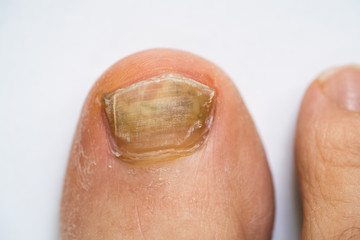 Broken Foot Nail And Fungal Infection