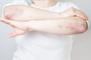 Acute psoriasis on elbows is an autoimmune incurable dermatological skin disease. Large red, inflamed, flaky rash on the knees. Joints affected by psoriatic arthritis. - obrazy, fototapety, plakaty