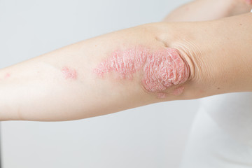 Acute psoriasis on elbows is an autoimmune incurable dermatological skin disease. Large red, inflamed, flaky rash on the knees. Joints affected by psoriatic arthritis. - obrazy, fototapety, plakaty