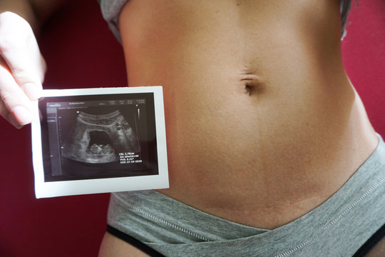 photograph of the embryo, results of perinatal screening, abdomen of a woman, cesarean scar, pregnancy 10 11 12 weeks, on a pink background                                 