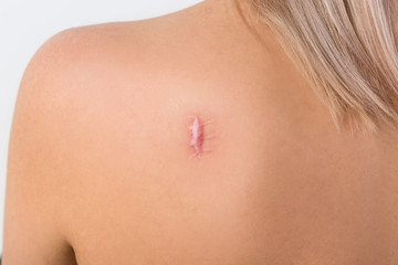 keloid scar on the back of a woman - 340241094