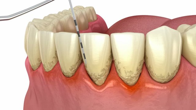 Periodontitis testing, gum recession process. Medically accurate 3D animation