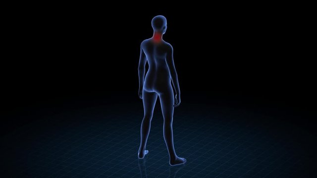 Girl with pathology. 3d body of women. Female human figure.