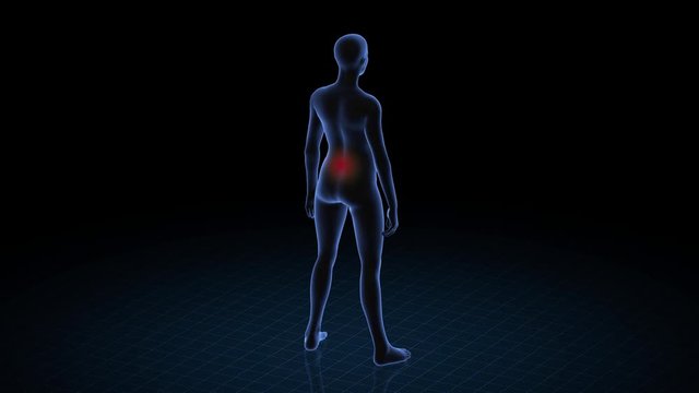Girl with pathology. 3d body of women. Female human figure.