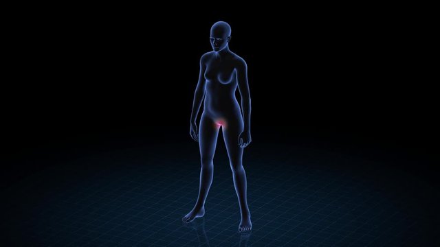 Girl with pathology. 3d body of women. Female human figure.