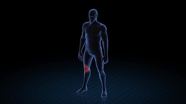 Man with pathology. 3d body of boy. Male human figure.