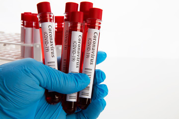 Coronavirus Blood Test in Laboratory