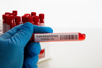 Coronavirus Blood Test in Laboratory