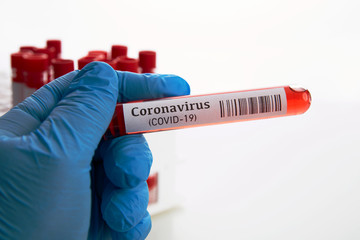 Coronavirus Blood Test in Laboratory
