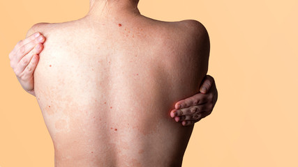 Allergic dermatitis on the skin of a woman's back. Skin disease. Neurodermatitis disease, eczema or...