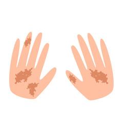 Freckles on the hands. Pigmentation on the skin. A pigmented spot on the skin of the hands. Vector illustration