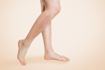 Smooth female legs, with varicose veins and swelling on the lower leg. Beige background. Copy...