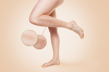 Female smooth beautiful legs, with varicose veins on the lower leg. Zoomed image of varicose veins, Before and after treatment. Beige background. A copy of the space.The concept of varicose disease