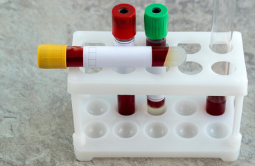 test for coronavirus. medical flask with a blood test for the virus COVID-19