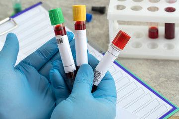 tested positive for the coronavirus. medical flask with a blood test for the virus COVID-19. doctor in rubber gloves holds a tube.