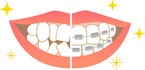 Tooth alignment Dental care Before orthodontic treatment After treatment
