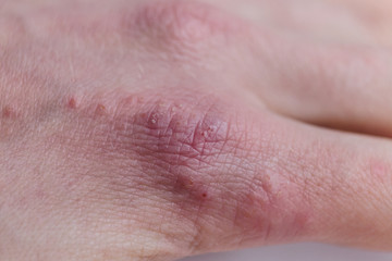 Fototapeta premium close-up of a patients fingers showing plaques of dry skin typically seen with psoriasis