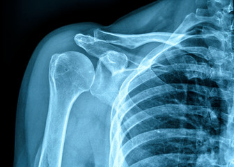 X-ray film of human shoulder