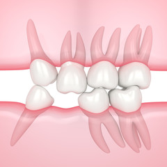 3d render of teeth sliding towards the area of missing tooth in order to fill the gap