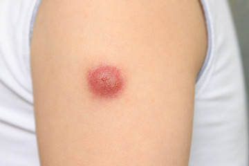 Hand of a kid with a reaction to the BCG vaccine