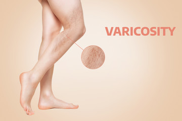 Varicosity. Smooth female legs, shown in profile, show varicose veins. Enlarged image of vessels in...