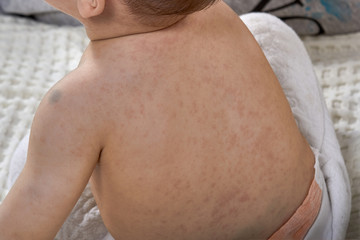 roseola rash a viral rash on the skin of a child