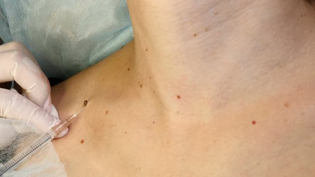 Female doctor surgeon making anesthesia pain-relieving injection before removing wart, papillomas on young woman body, close-up view. Removing nevus or birthmark. Cosmetic treatment concept. 4 k