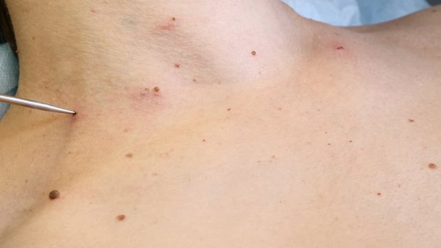 In beauty clinic. Beautician removs mole in surgical procedure by cutting it out with medical tools and equipment. Woman gets medical mole and papillomas removing in medical centre. 4k