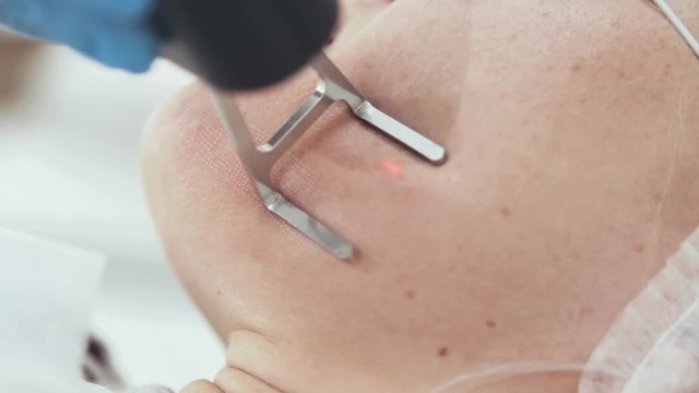 laser face cleaning CO2 close-up